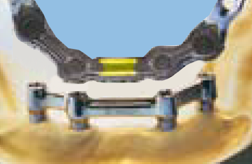 Bredent VSP Bar Attachments