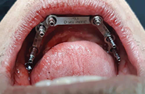 Fast Protec Easy Bar System