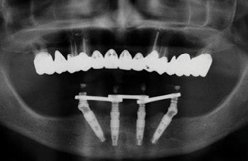 Fast Protec Easy Bar System