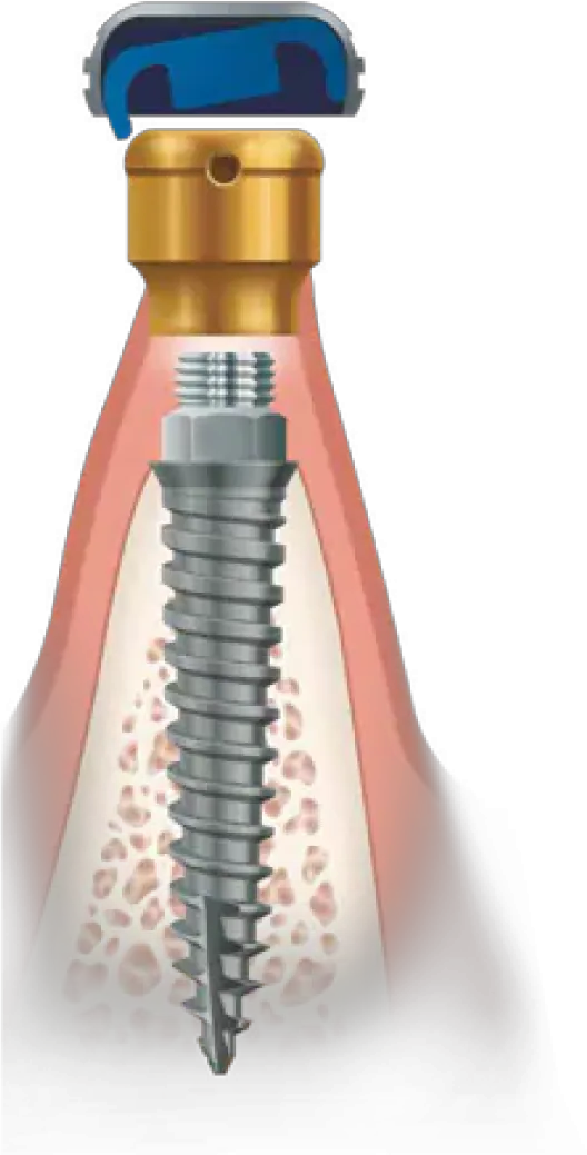 LOCATOR LODI IMPLANT ABUTMENTS