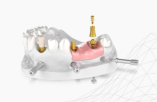 IPD Abutments