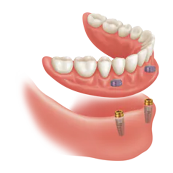 IMPLANT ATTACHMENT