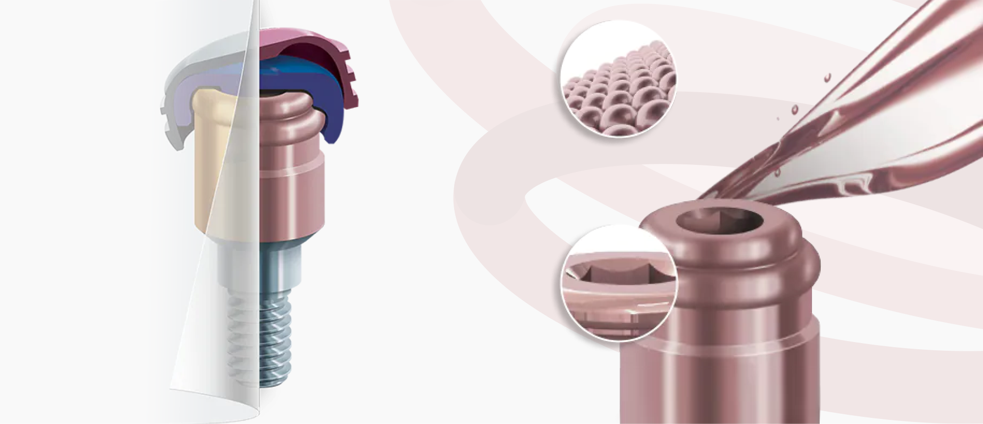 LOCATOR OVERDENTURE IMPLANT SYSTEM