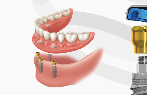 LOCATOR Abutments
